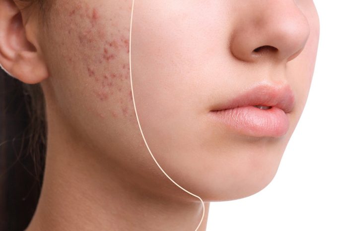 The Most Effective Cosmetic Products For Treating Acne
